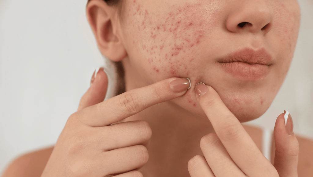 What causes pimple problems to appear in adolescents